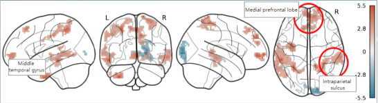Increased connectivity in the amygdala